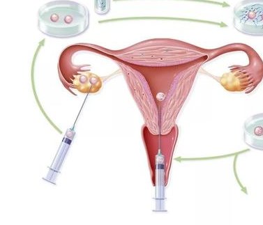 三代胚胎筛查染色体异常这几项结果判断